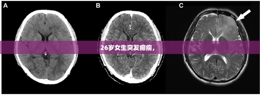 26岁女生突发癫痫， 